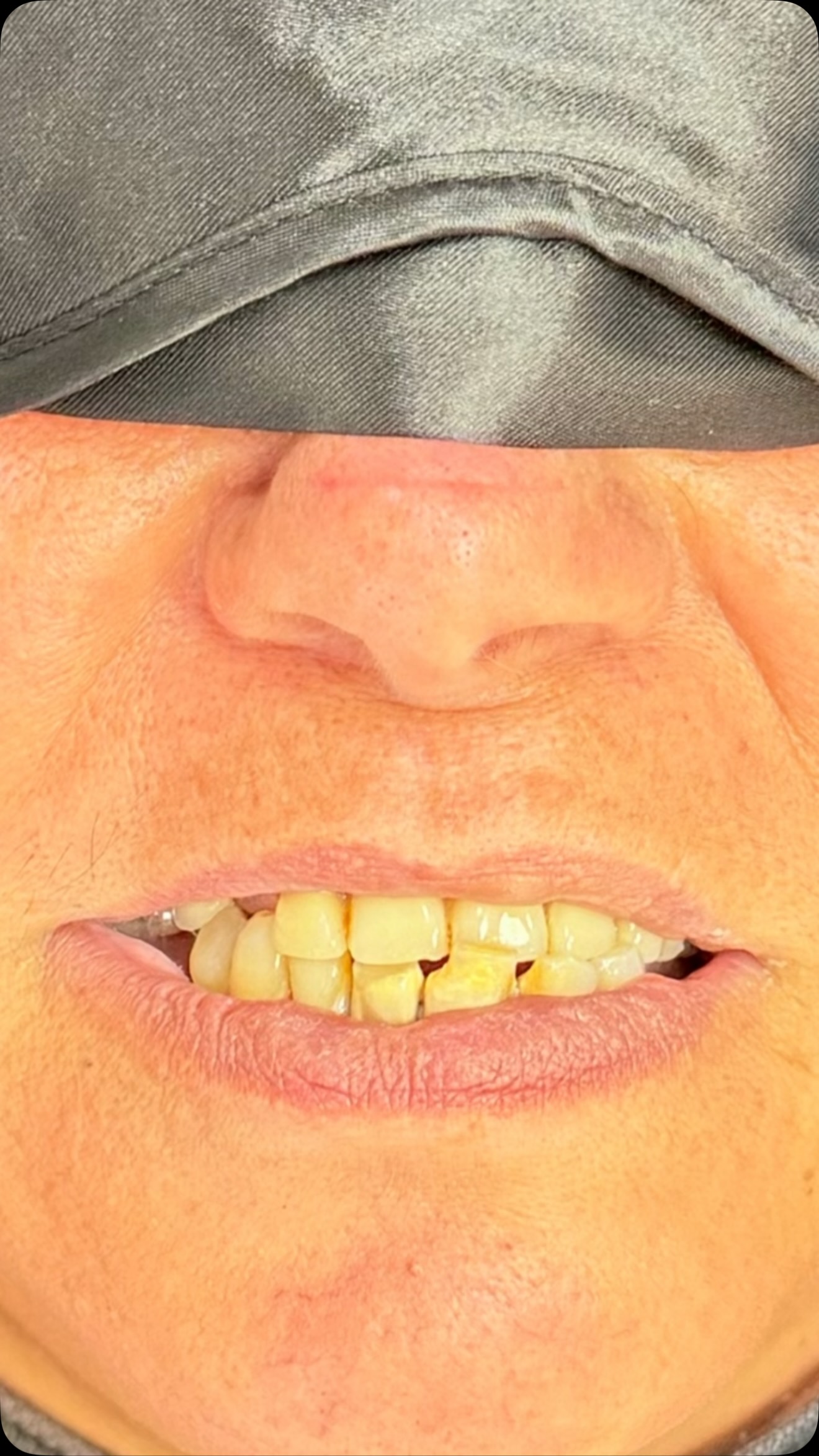 Antes: dentes desgastados e danificados de paciente real