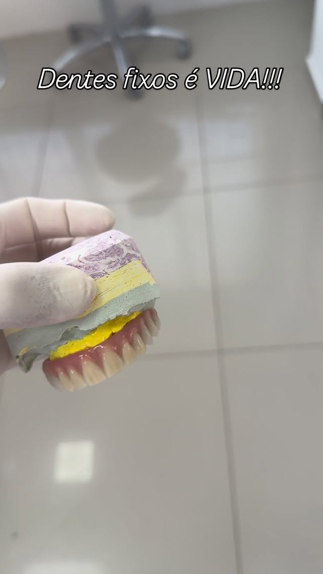 Prótese fixa real em fase final de laboratório